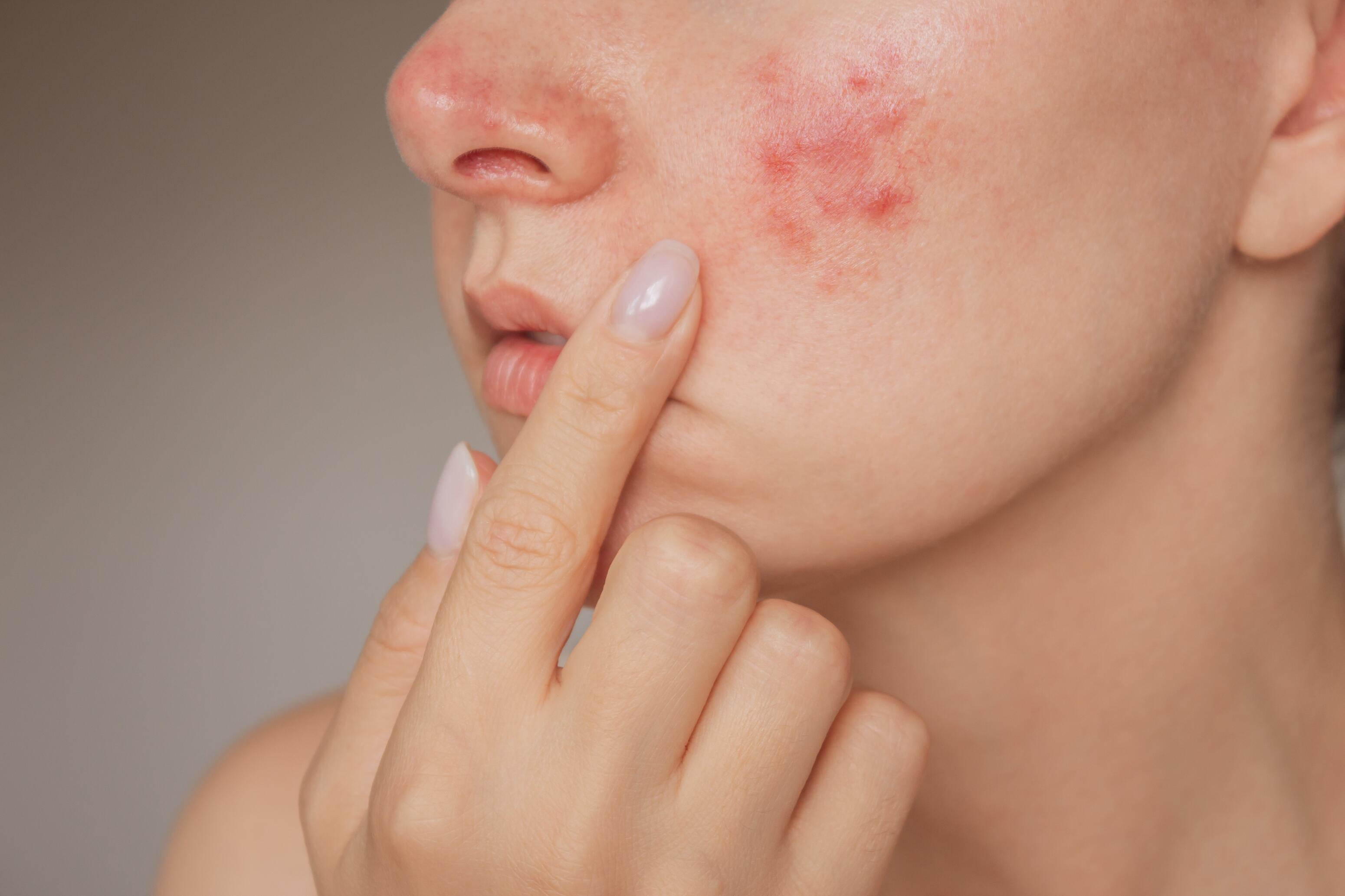 Skin infections